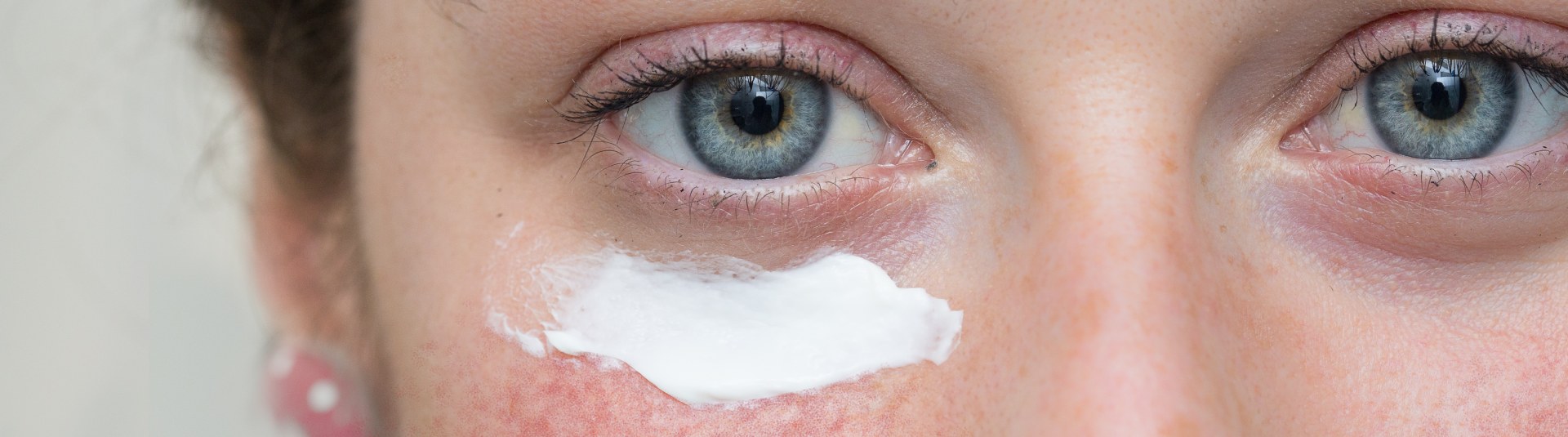 Новые достижения в лечении розацеа: обзор современных методик и препаратов