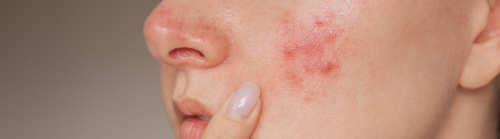 Чем лечить розовые угри на лице