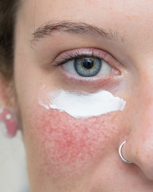 Новые достижения в лечении розацеа: обзор современных методик и препаратов